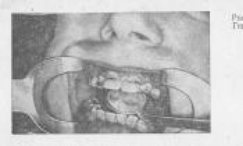 Заболевания твердых тканей зуба