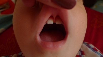 Нужно ли подрезать короткую уздечку верхней губы у детей и зачем